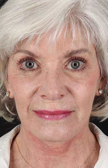 Neck Lift Before & After Patient #6665