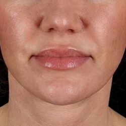 Neck Lift Before & After Patient #6676