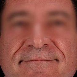Neck Lift Before & After Patient #6698