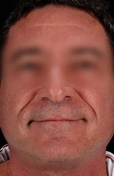 Neck Lift Before & After Patient #6698