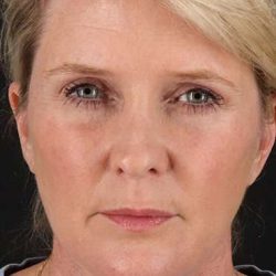 Neck Lift Before & After Patient #6720