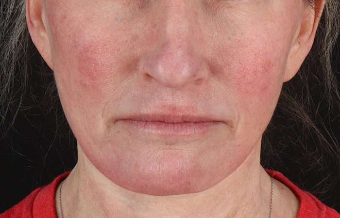 Neck Lift Before & After Patient #6731