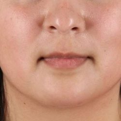 Neck Lift Before & After Patient #6743