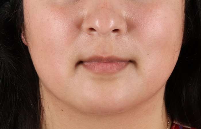 Neck Lift Before & After Patient #6743