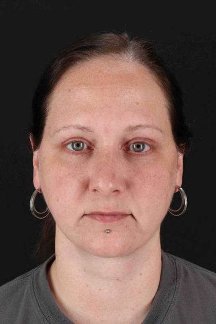 Neck Lift Before & After Patient #6756