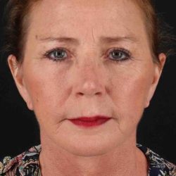 Neck Lift Before & After Patient #6777