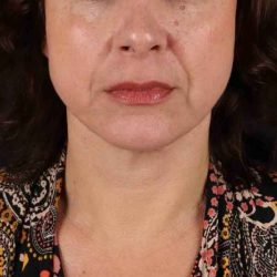 Neck Lift Before & After Patient #6797