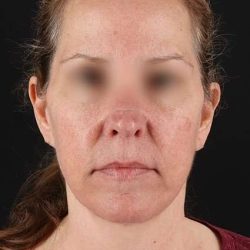 Neck Lift Before & After Patient #6838