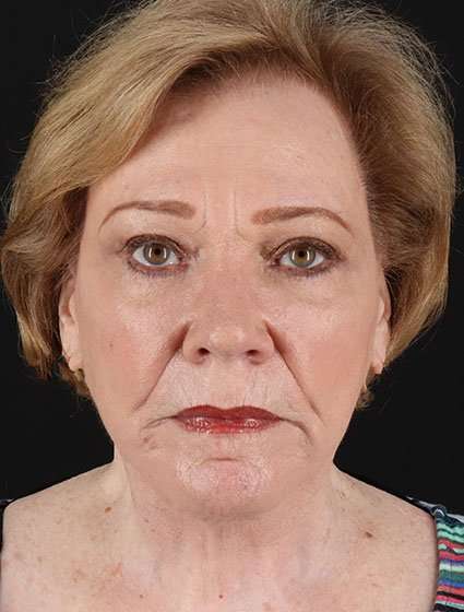 Neck Lift Before & After Patient #6845