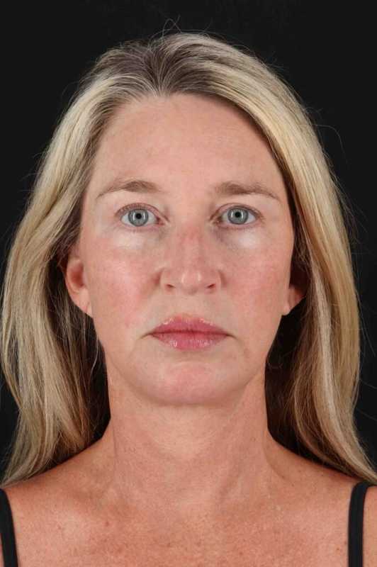 Neck Lift Before & After Patient #6867