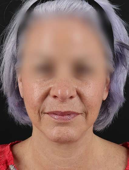 Neck Lift Before & After Patient #6878