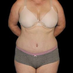 Abdominoplasty (Tummy Tuck) Before & After Patient #625