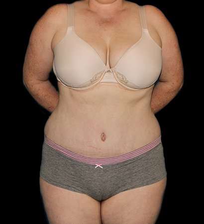 Abdominoplasty (Tummy Tuck) Before & After Patient #625
