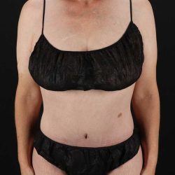 Cosmetic Body Lift Before & After Patient #1218