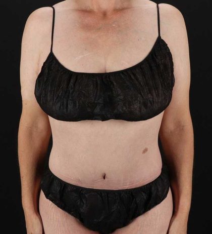 Cosmetic Body Lift Before & After Patient #1218