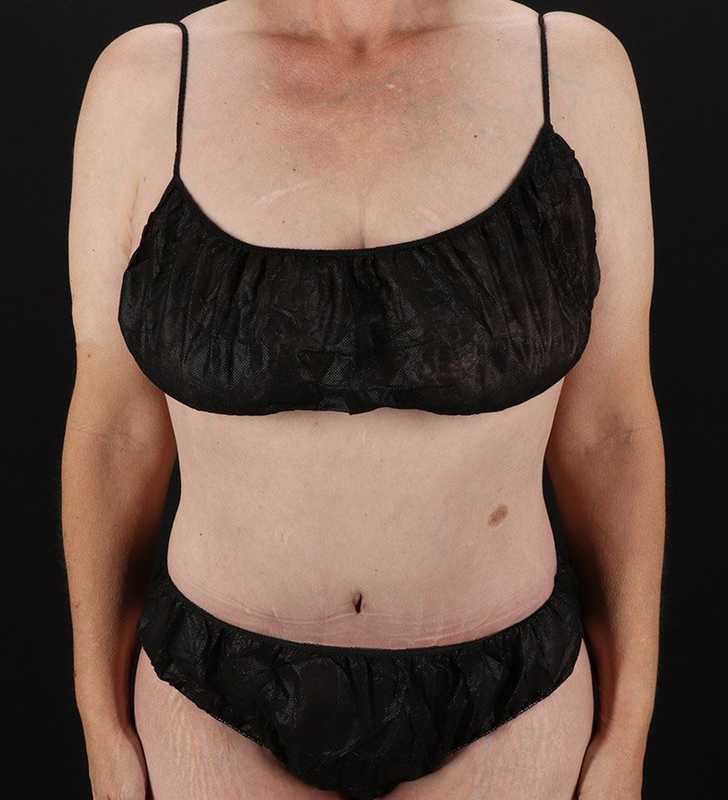 Cosmetic Body Lift Before & After Patient #1218