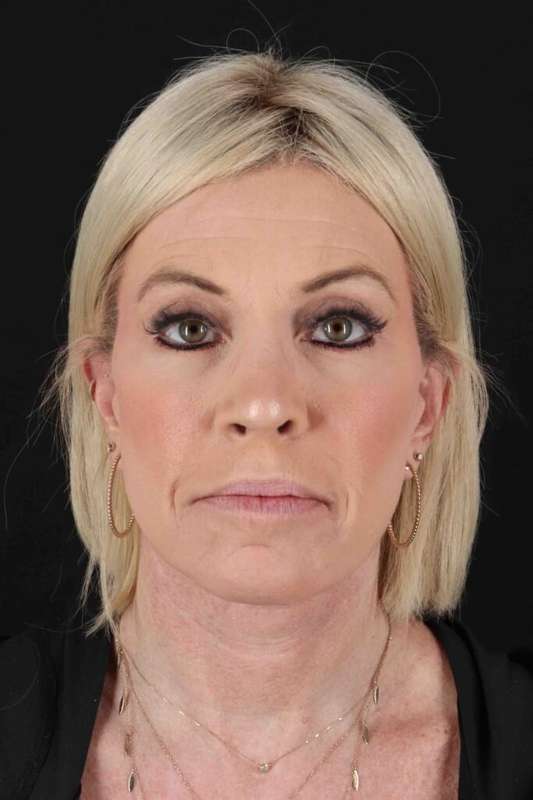 Neck Lift Before & After Patient #6920