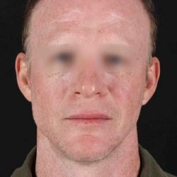 CO2 Laser Before & After Patient #6931