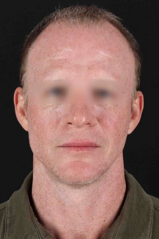 CO2 Laser Before & After Patient #6931