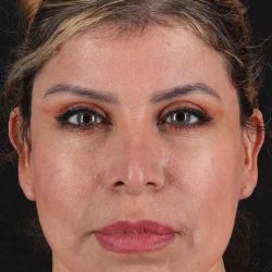 CO2 Laser Before & After Patient #6942