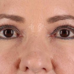 CO2 Laser Before & After Patient #6986
