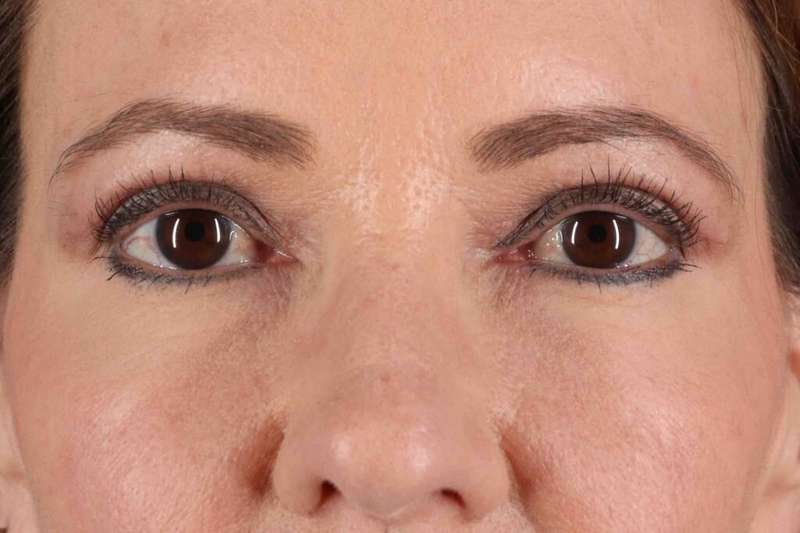 CO2 Laser Before & After Patient #6986