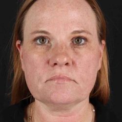 CO2 Laser Before & After Patient #6997
