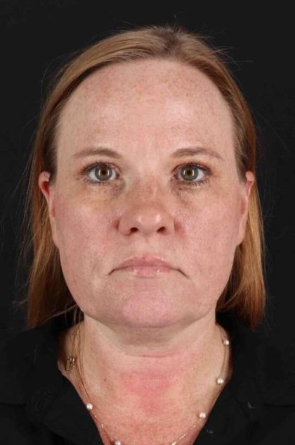CO2 Laser Before & After Patient #6997