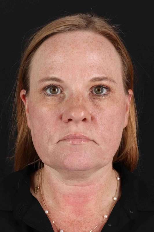 CO2 Laser Before & After Patient #6997