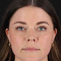 CO2 Laser Before & After Patient #7008