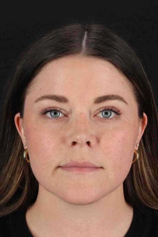 CO2 Laser Before & After Patient #7008