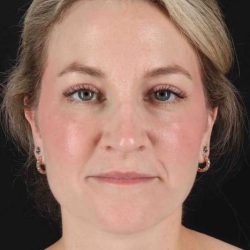 CO2 Laser Before & After Patient #7019