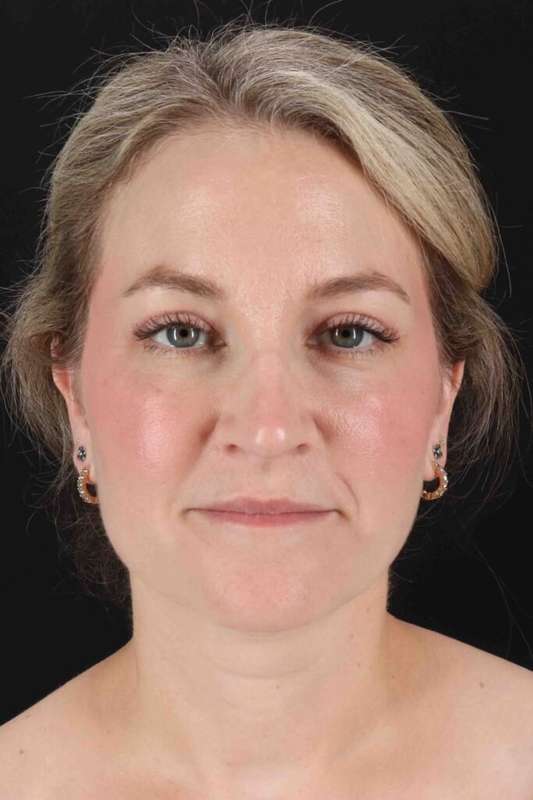 CO2 Laser Before & After Patient #7019