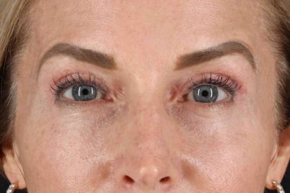 CO2 Laser Before & After Patient #7030