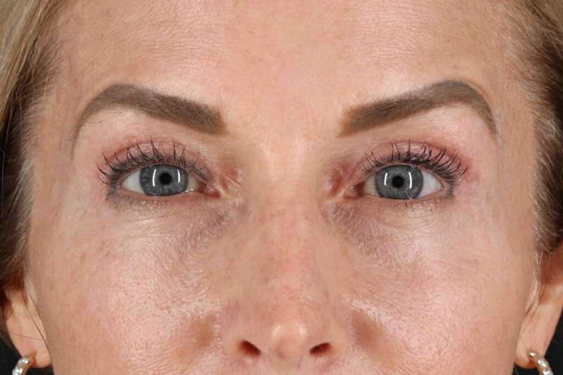 CO2 Laser Before & After Patient #7030