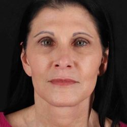CO2 Laser Before & After Patient #7063