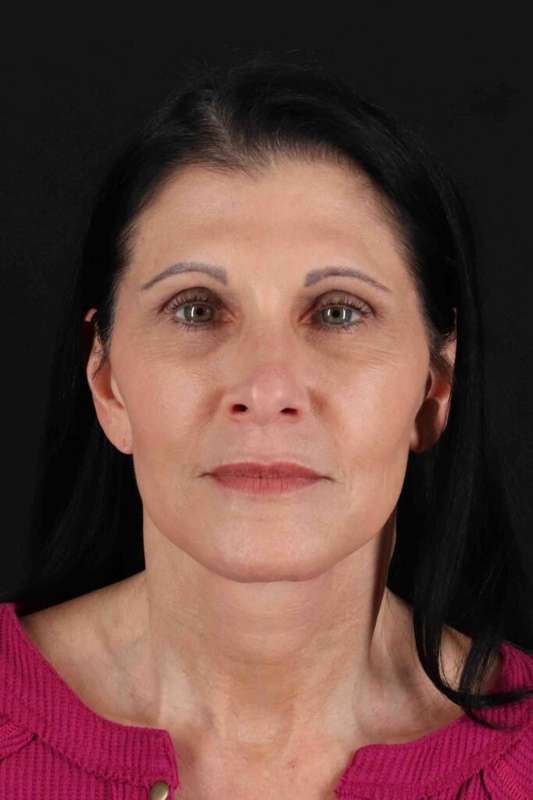 CO2 Laser Before & After Patient #7063