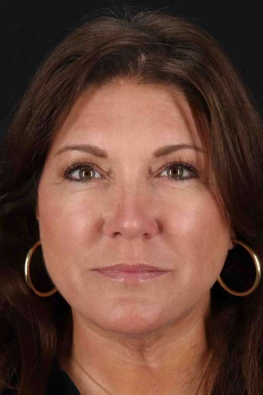 CO2 Laser Before & After Patient #7085