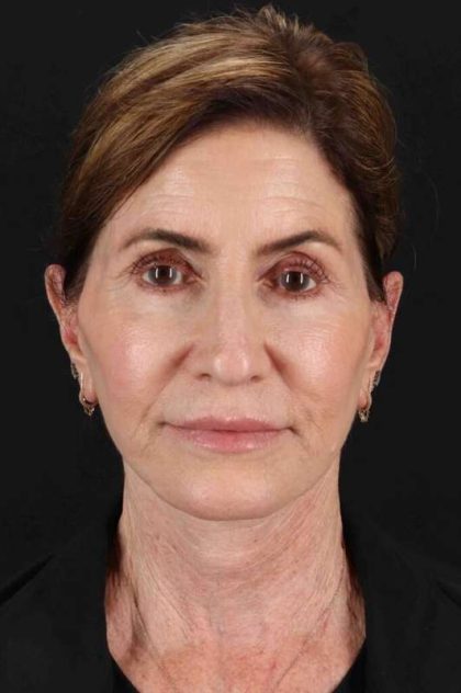 CO2 Laser Before & After Patient #7096