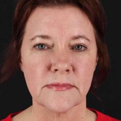 CO2 Laser Before & After Patient #7099