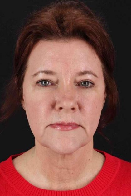 CO2 Laser Before & After Patient #7099
