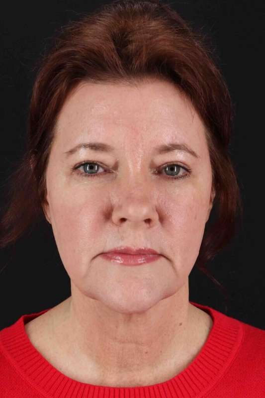 CO2 Laser Before & After Patient #7099