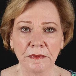 CO2 Laser Before & After Patient #7106