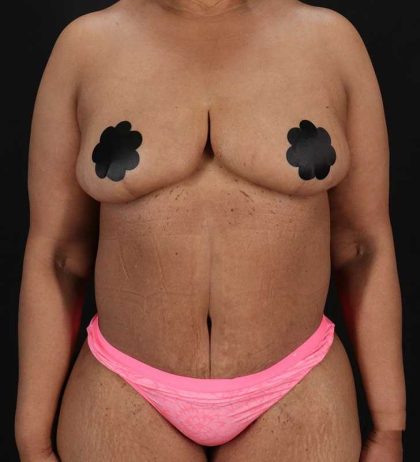 Cosmetic Body Lift Before & After Patient #1234