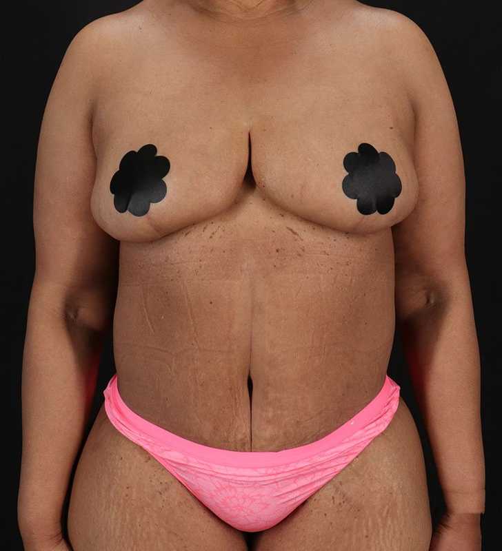 Cosmetic Body Lift Before & After Patient #1234