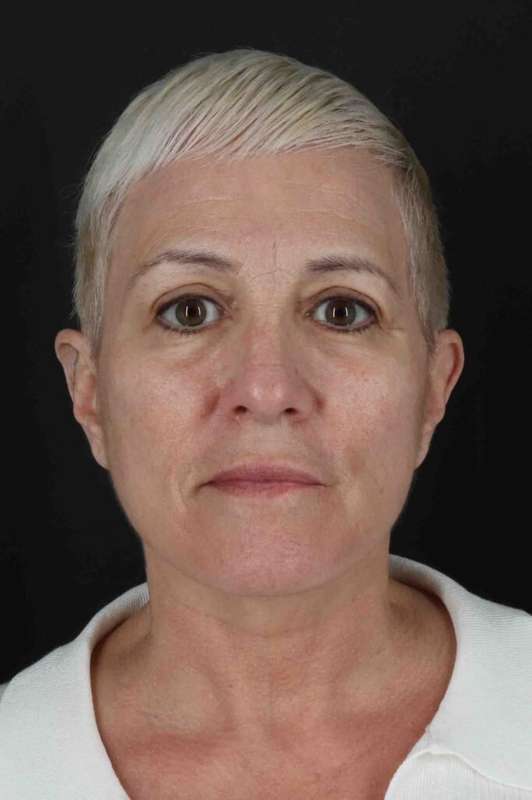CO2 Laser Before & After Patient #7117