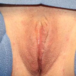 Labiaplasty Before & After Patient #1240