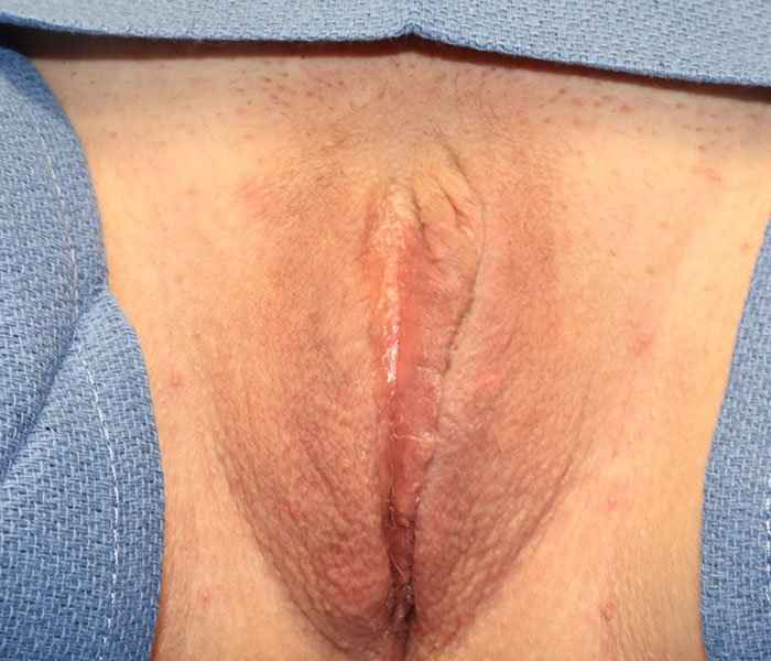 Labiaplasty Before & After Patient #1240