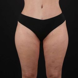 Liposuction Before & After Patient #1249