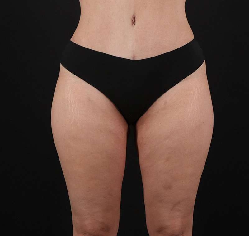 Liposuction Before & After Patient #1249